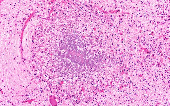 1B8 Encephalitis, CMV (Case 1) 9