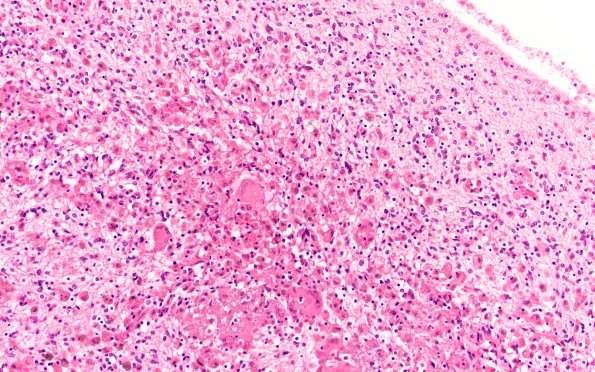 1B9 Encephalitis, CMV (Case 1) 3