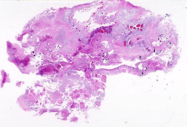 2B1 CMV, Disseminated (Case 2) H&E whole mount 1