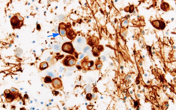 2C7 CMV, Disseminated (Case 2) GFAP 3 copy