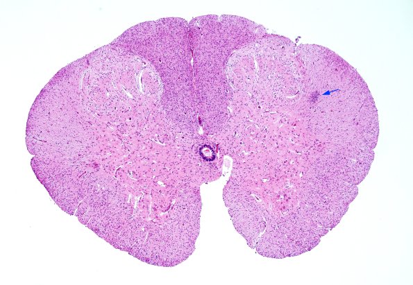 3B1 CMV, Premature, 46 days age (Case 3) H&E spinal cord 1 copy