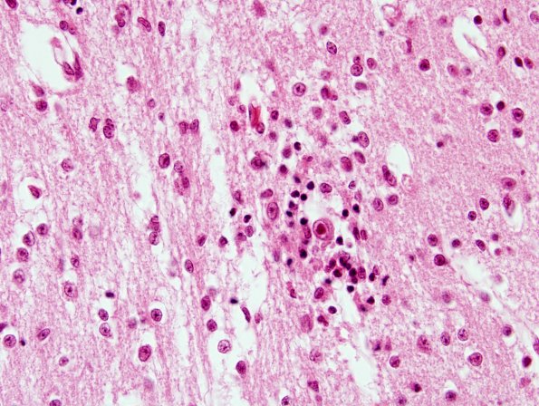 3B2 CMV, Premature, 46 days age (Case 3) H&E spinal cord 2