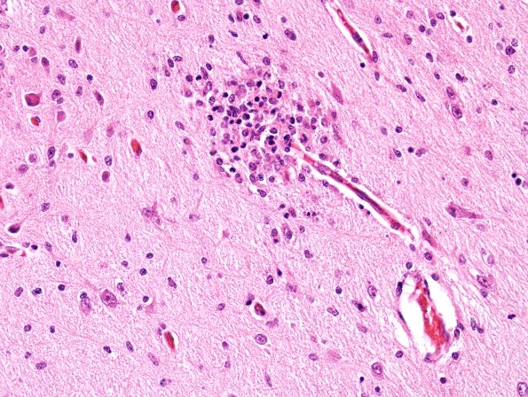 3B3 CMV, Premature, 46 days age (Case 3) H&E spinal cord 3