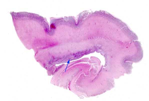 4B1 CMV, disseminated (Case 4) N3 H&E whole mount copy