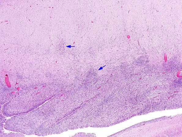 4B2 CMV, disseminated (Case 4) N3 H&E 6 copy