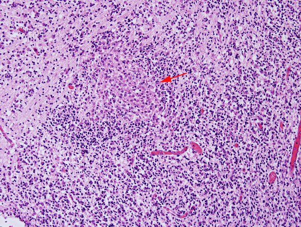 4B3 CMV, disseminated (Case 4) N3 H&E 1 copy