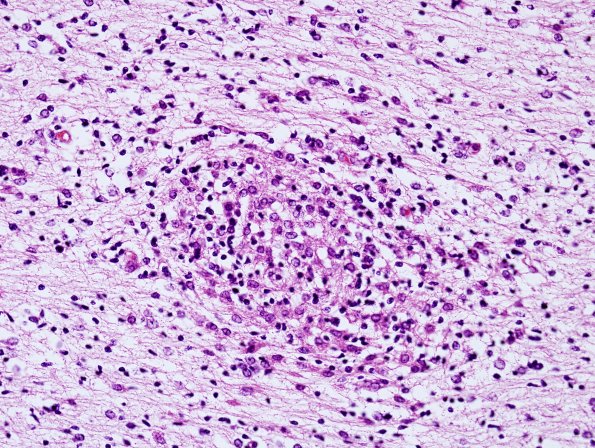 4B4 CMV, disseminated (Case 4) N3 H&E 4