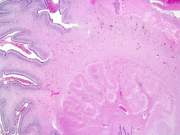 4C1 CMV, disseminated (Case 4) N9 H&E whole mount