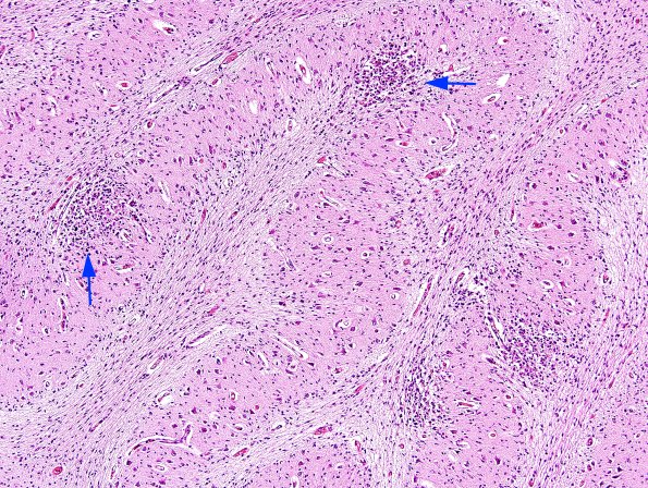 4C2 CMV, disseminated (Case 4) N9 H&E 3 copy