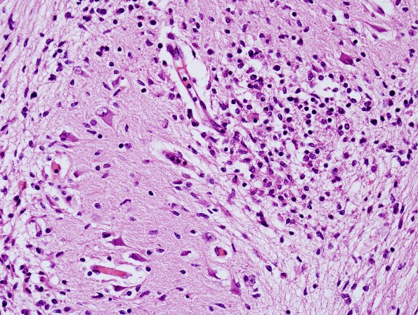 4C3 CMV, disseminated (Case 4) N9 H&E 1