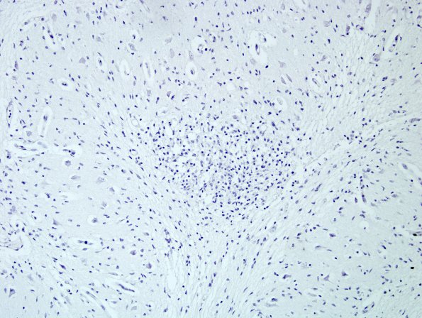 4D1 CMV, disseminated (Case 4) N9 Anti-CMV 1