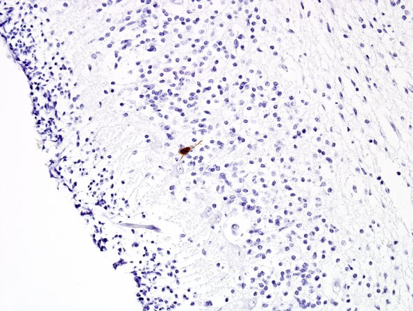 4D2 CMV, disseminated (Case 4) N9 Anti-CMV 2