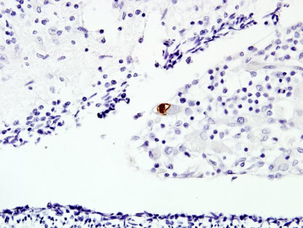 4D3 CMV, disseminated (Case 4) N9 Anti-CMV 4