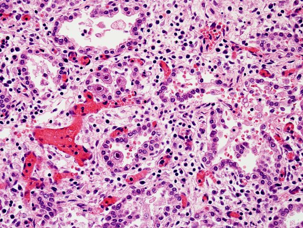 4E1 CMV, disseminated, lung (Case 4) H&E 2