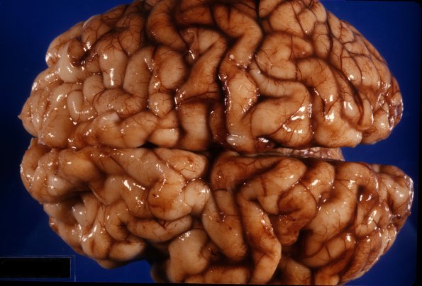 5A1 Encephalitis, Cytomegalovirus (Case 5) 2