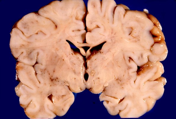 5A3 Encephalitis, Cytomegalovirus (Case 5) 7