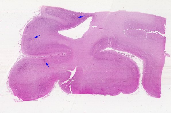 5B1  Encephalitis, Cytomegalovirus (Case 5) H&E whole mount copy