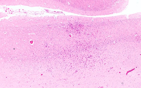 5B2 CMV Encephalitis, neonatal (Case 5) H&E 1