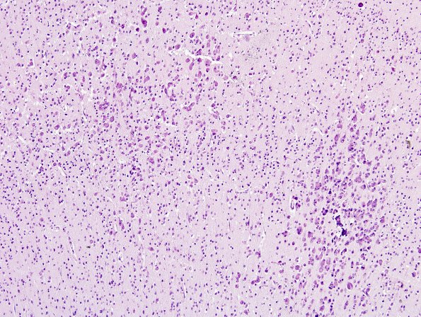 5B3 CMV Encephalitis, neonatal (Case 5) H&E 3