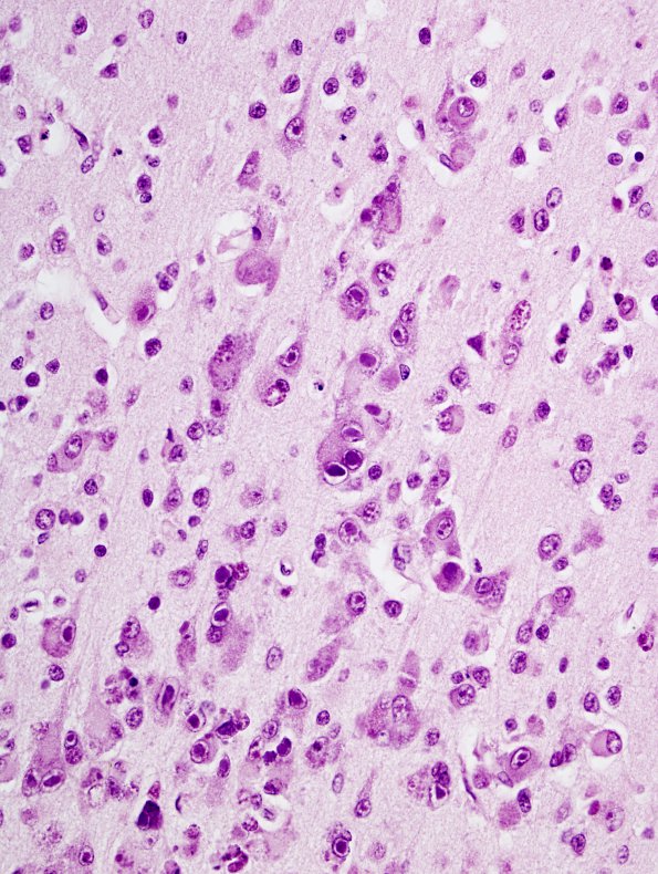 5B4 CMV Encephalitis, neonatal (Case 5) H&E 5