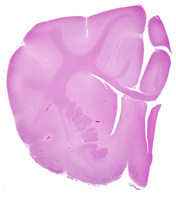 2A1 Meningoencephalitis, canine distemper fox (Case 2) H&E whole mount