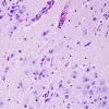 2A2 Meningoencephalitis, canine distemper fox (Case 2) H&E 3