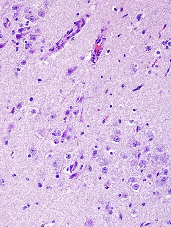 2A2 Meningoencephalitis, canine distemper fox (Case 2) H&E 3