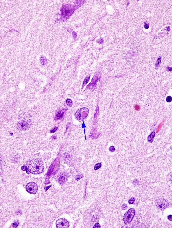 2A3 Meningoencephalitis, canine distemper fox (Case 2) H&E 4 copy