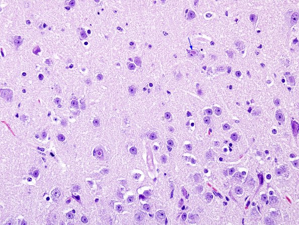 2A4 Meningoencephalitis, canine distemper fox (Case 2) H&E 2 copy