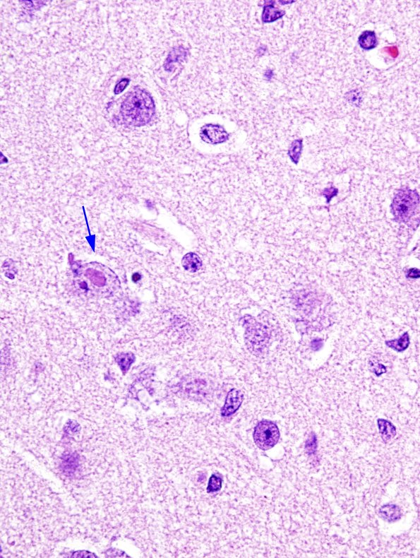 2A5 Meningoencephalitis, canine distemper fox (Case 2) H&E 6 copy