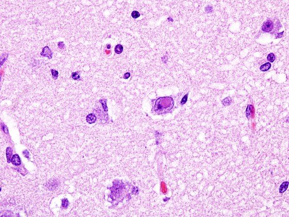 2A6 Meningoencephalitis, canine distemper fox (Case 2) H&E 8