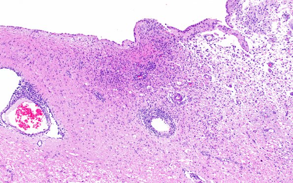 3A1 Meningoencephalitis, canine distemper - tiger (AANP 2010, Case 8) H&E 1