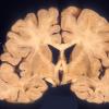 1A1 HIV, Encephalitis (Case 1) 2