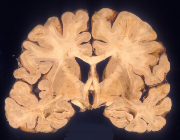 1A1 HIV, Encephalitis (Case 1) 2