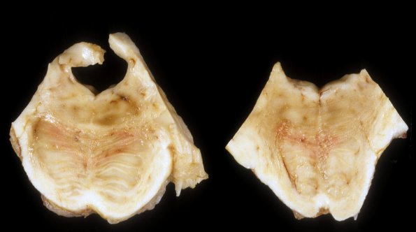 1A2 HIV, CMV, necrotizing Leukoencephalopathy pons (Case 1) A3