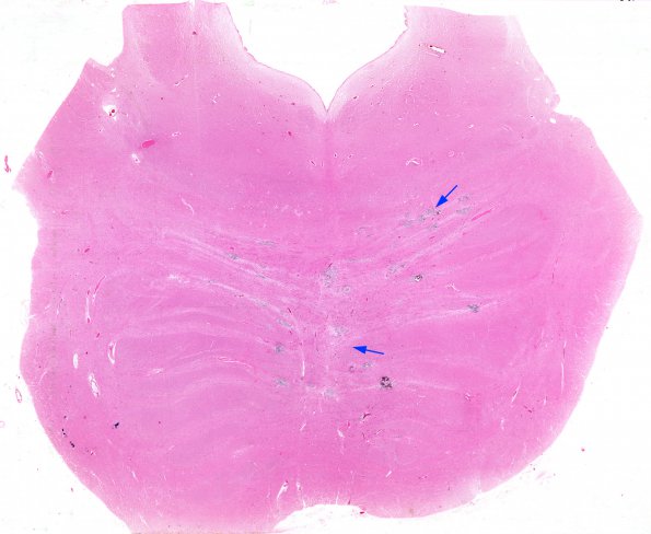 1B1 HIV & MTX-like Leukoencephalopathy (Case 1) Pons H&E whole mount (2) copy A