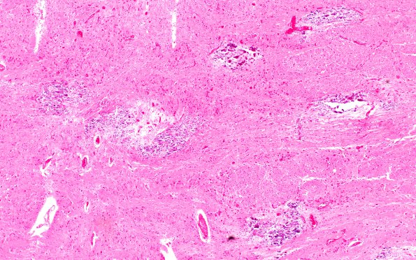 1B2 HIV & MTX-like Leukoencephalopathy (Case 1) Pons H&E 25