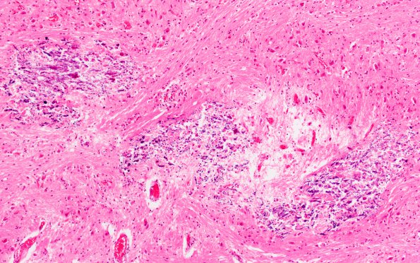 1B3 HIV & MTX-like Leukoencephalopathy (Case 1) Pons H&E 26