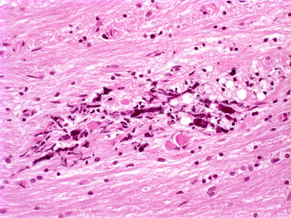 1B4 Necrotizing Leukoencephalopathy (Case 1) 1