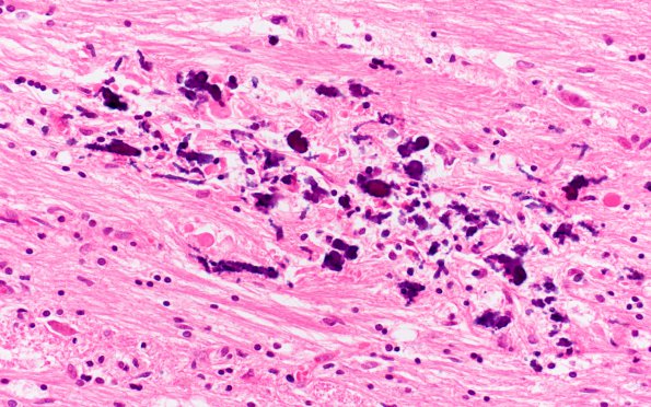 1B5 HIV & MTX-like Leukoencephalopathy (Case 1) Pons H&E 29