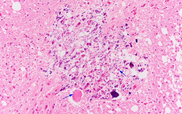 1B6 HIV & MTX-like Leukoencephalopathy (Case 1) Pons H&E 13 copy