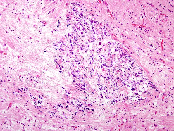 1B7 HIV & MTX-like Leukoencephalopathy (Case 1) Pons H&E 1