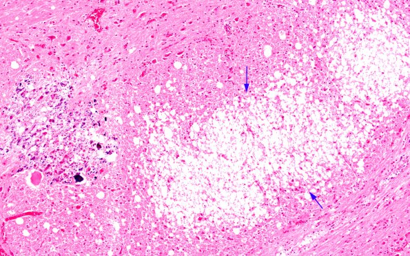 1B8 HIV & MTX-like Leukoencephalopathy (Case 1) Pons H&E 18 copy