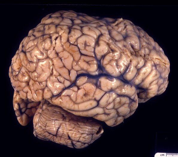 1A1 Encephalitis, neonatal HIV, CMV, 15 mo (Case 1) 3