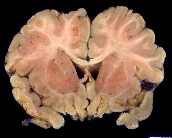 1A2 Encephalitis, neonatal HIV, CMV, 15 mo (Case 1) 2