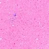 1B1 Encephalitis, neonatal HIV, CMV, 15 mo (Case 1) N9 medulla H&E 5 copy