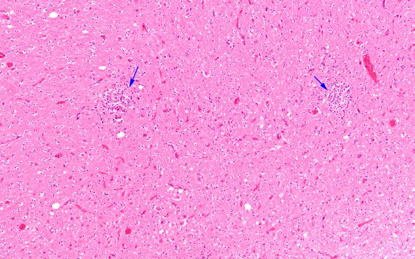 1B1 Encephalitis, neonatal HIV, CMV, 15 mo (Case 1) N9 medulla H&E 5 copy