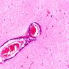 1B10 Encephalitis, neonatal HIV, CMV, 15 mo (Case 1) N2 2