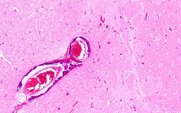 1B10 Encephalitis, neonatal HIV, CMV, 15 mo (Case 1) N2 2