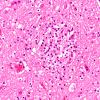 1B2 Encephalitis, neonatal HIV, CMV, 15 mo (Case 1) N9 medulla H&E 11